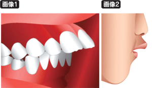 上顎前突、上アゴが突き出た特徴的な顔つき