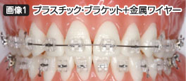 プラスチック・ブラケット＋金属ワイヤー