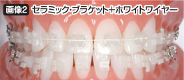 セラミック・ブラケット＋ホワイトワイヤー