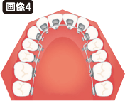 歯の裏側に装着するブラケット