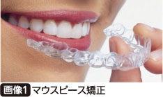 マウスピース矯正